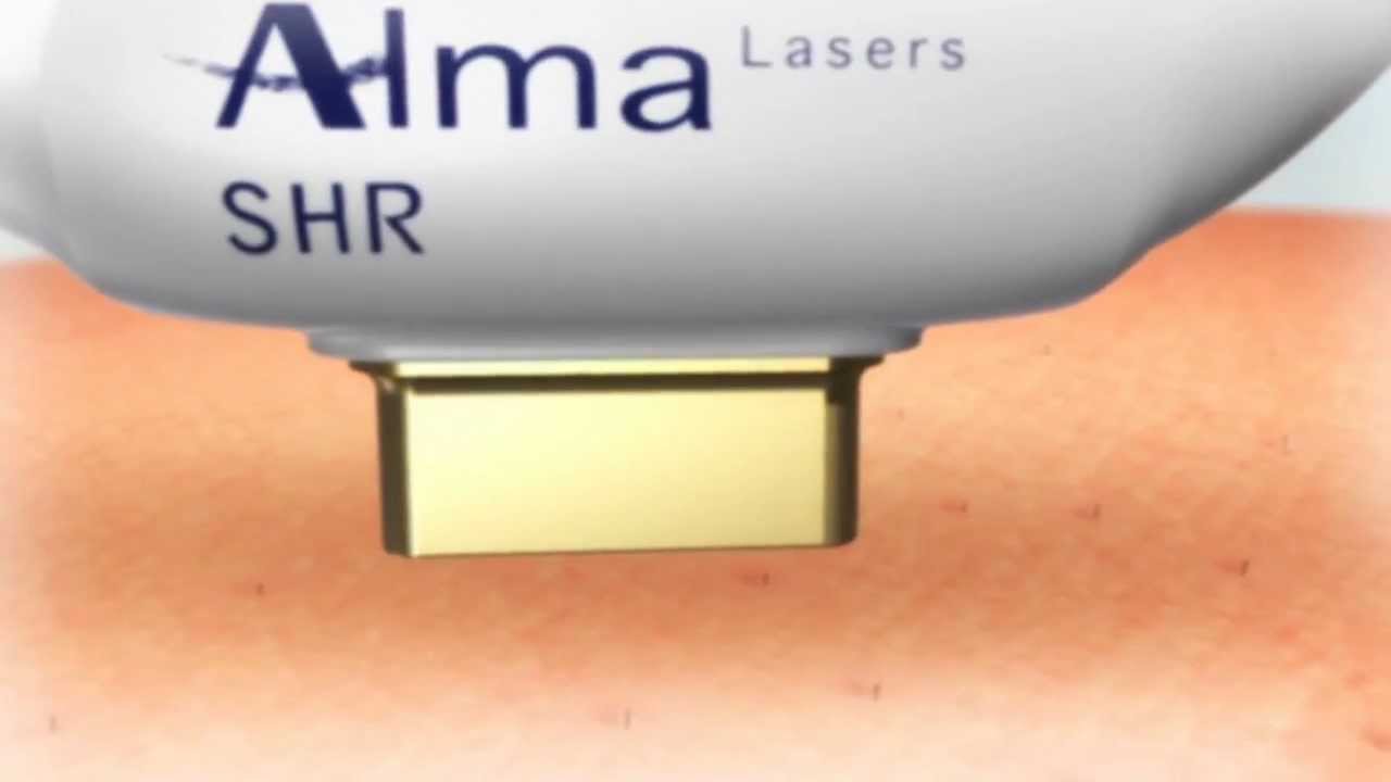 LASER IPL